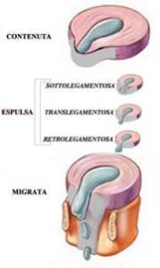 ernia_discale_01